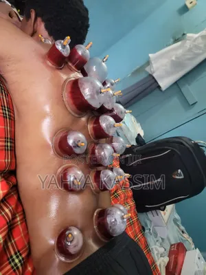 Hijama,(Cupping Therapy)