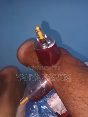 Hijama,(Cupping Therapy)