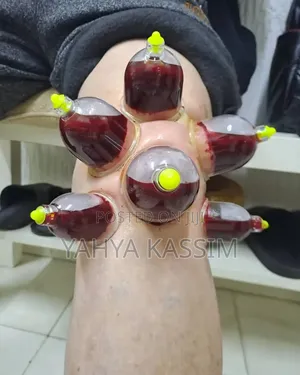Hijama,(Cupping Therapy)
