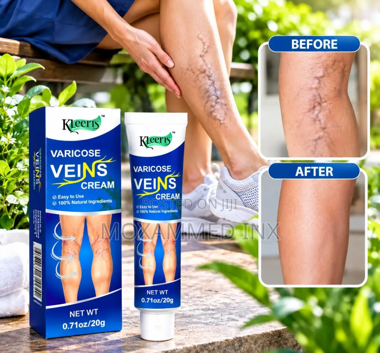 Kleeris Varicose Veins Cream(net Weight 0.61 Oz / 20 G),