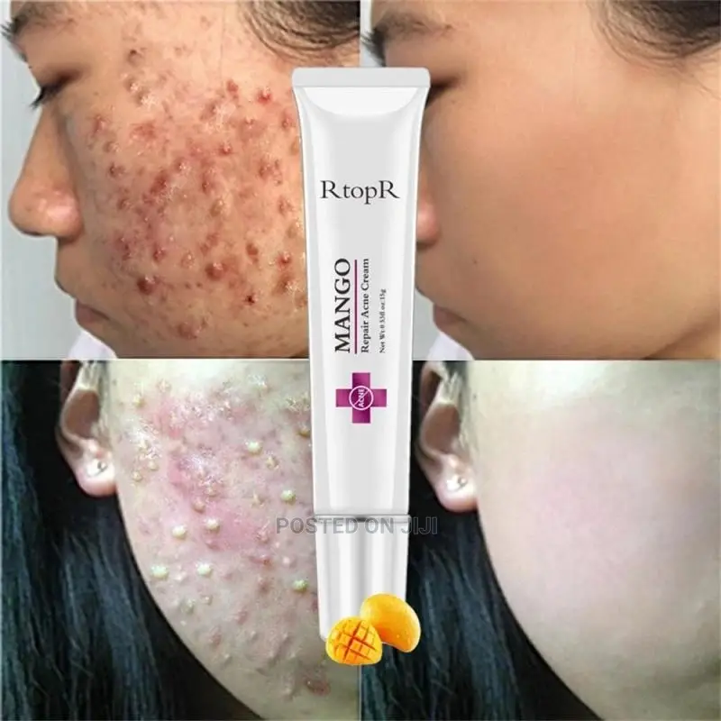 Acne Repear Cream