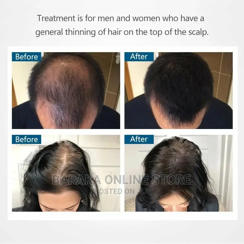Kirkland Minoxidil