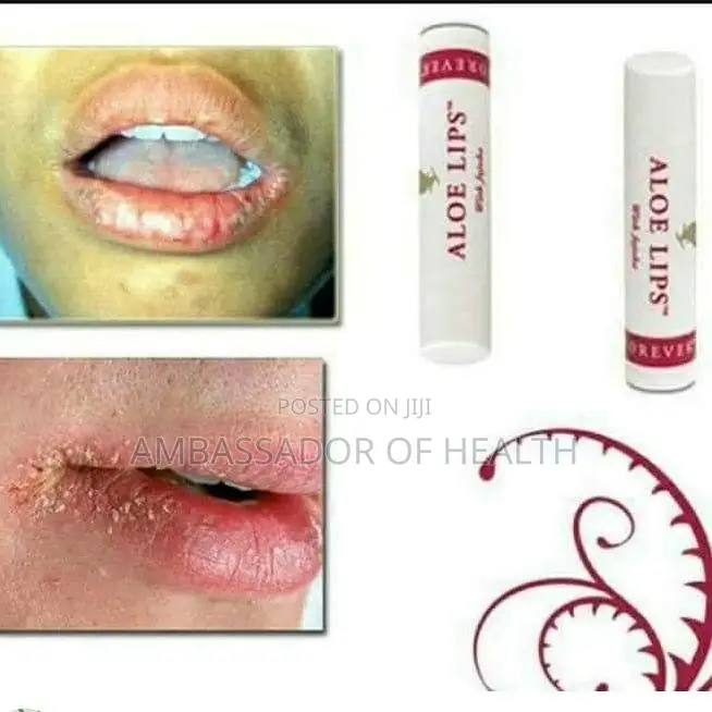 Aloe Lips Kwa Midomo Inayopasuka Pasuka
