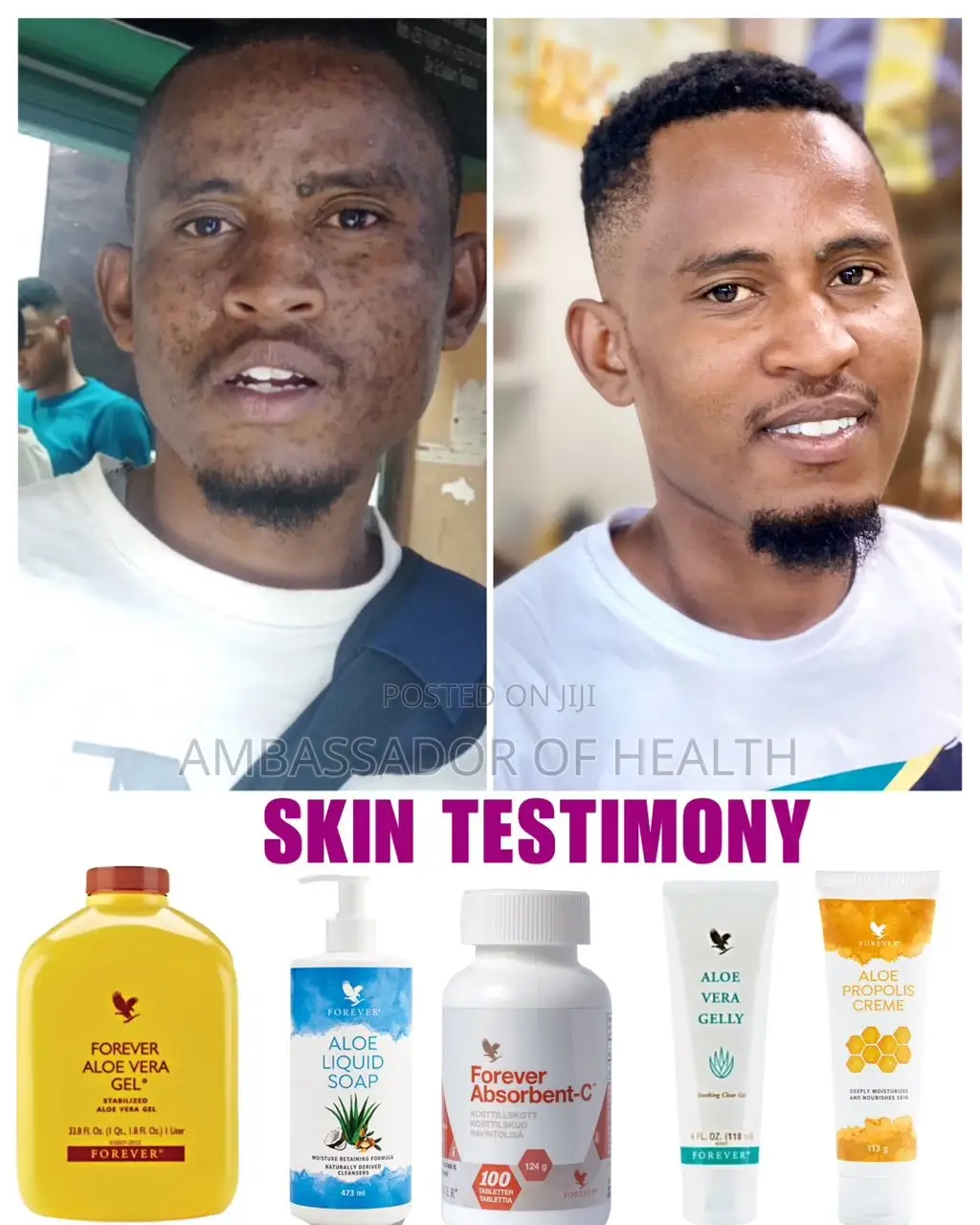 Pendezesha Ngozi Yako Hatakama Imearibika Na Cream Na Jua