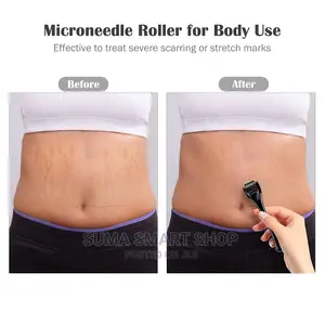Derma Roller System.(Kifaa Cha Urembo) .