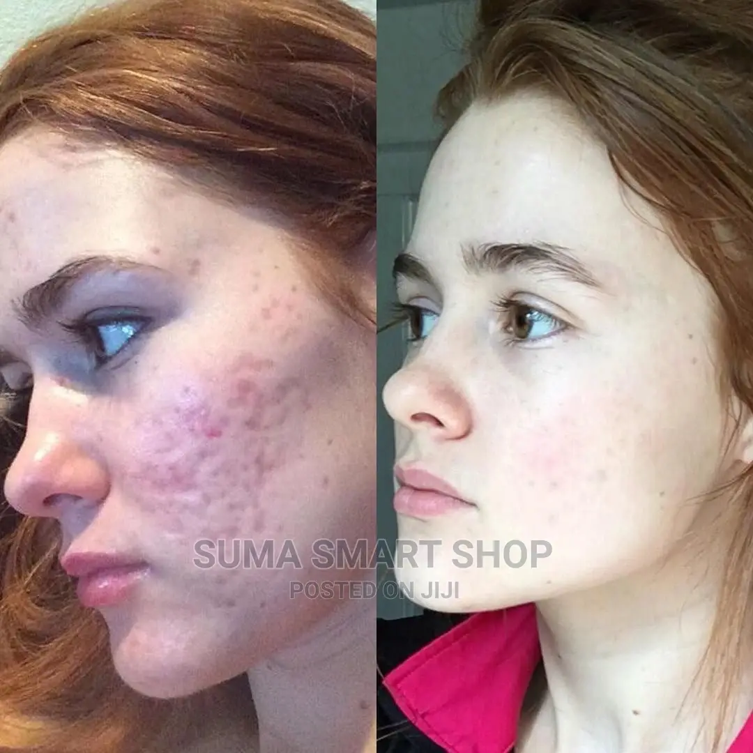 Derma Roller System.(Kifaa Cha Urembo) .
