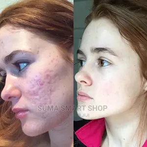 Derma Roller System.(Kifaa Cha Urembo) .