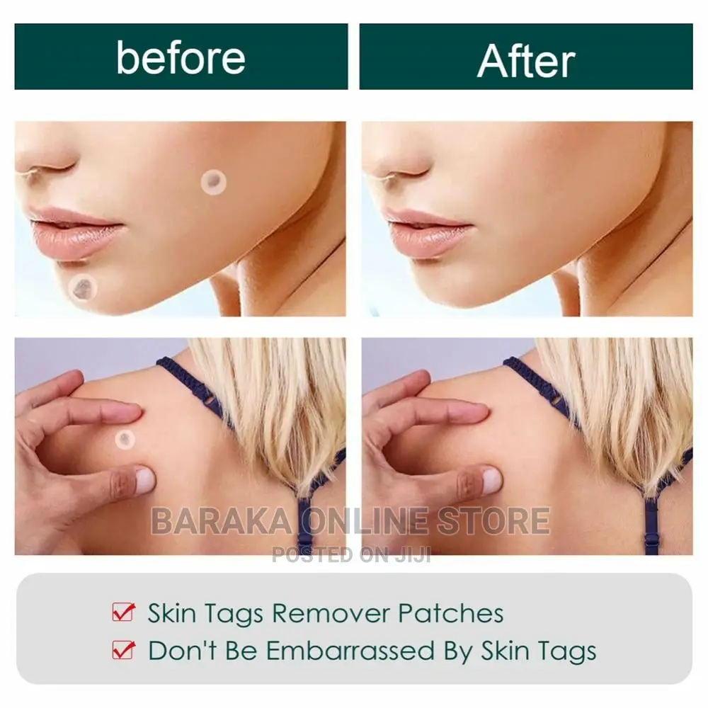 Skin Tag Remover Patch