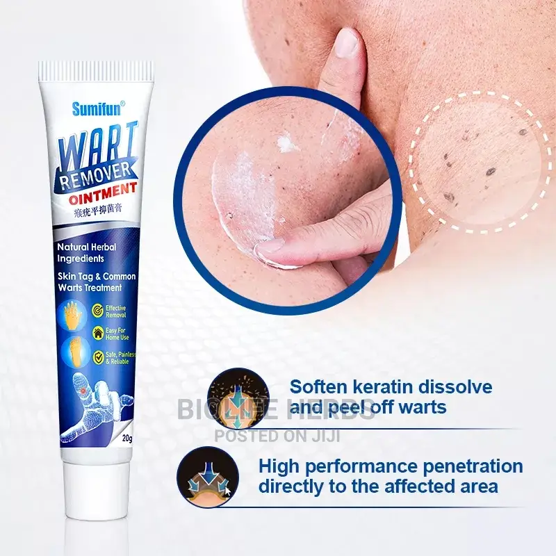 Warts Removal