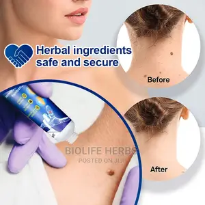 Warts Removal