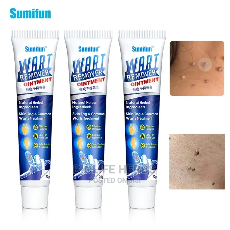 Warts Removal