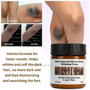 Cream Ya Kuondoa Sugu Na Weusi Wowote