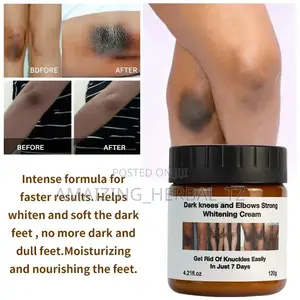 Cream Ya Kuondoa Sugu Na Weusi Wowote