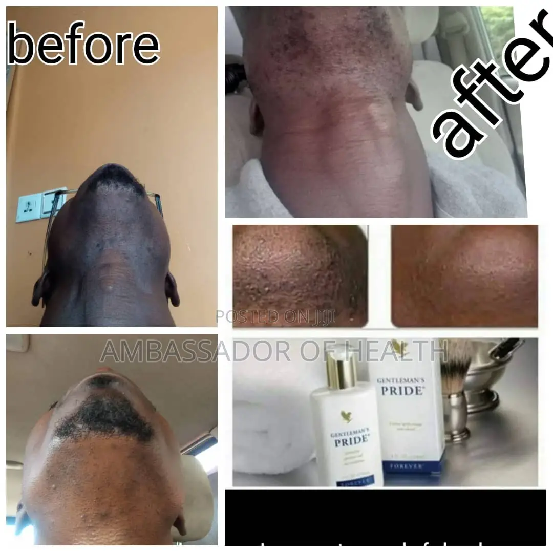 After Shave Inaondoa Vipele Vyote Baada Ya Kushave
