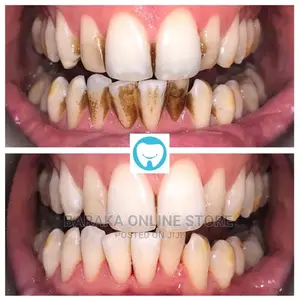 Teeth Whitening
