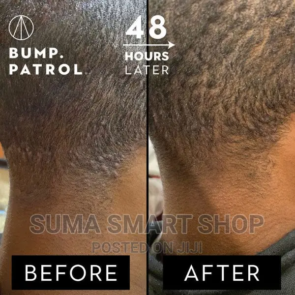 Bump Patrol Solution .(Ondoa Vipele Kwenye Ndevu)