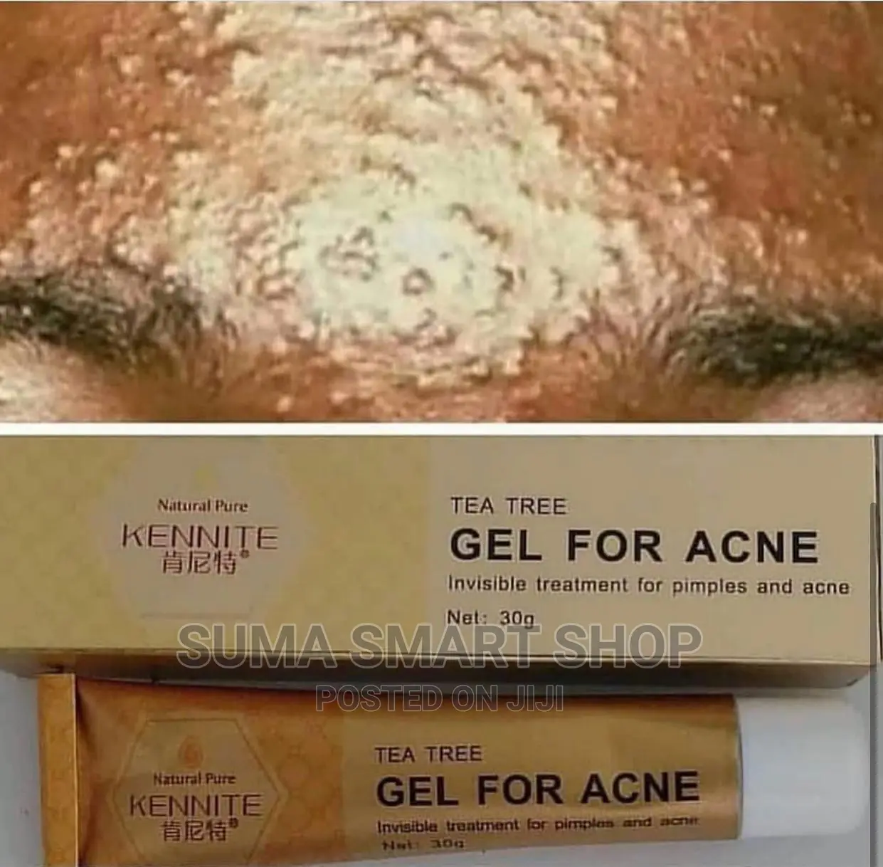 KENNITE Acne Gel . (Futa Chunusi ) .