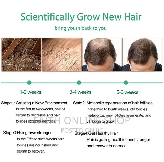 Neo Hair Lotion Treatment Stop Hair Loss Hair Growth Serum