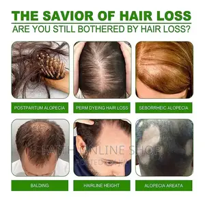 Neo Hair Lotion Treatment Stop Hair Loss Hair Growth Serum