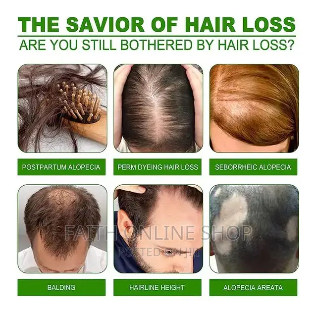 Neo Hair Lotion Treatment Stop Hair Loss Hair Growth Serum