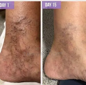 WIX Varicose Veins .(Futa Mishipa Ya Kijani Kwenye Ngozi )