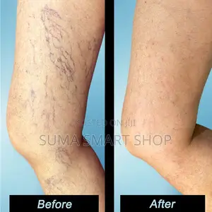 WIX Varicose Veins .(Futa Mishipa Ya Kijani Kwenye Ngozi )