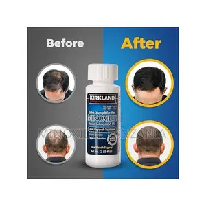 Photo - Kirkland Minoxidil Asili Kutoka USA Kwa Ukuaji Wa Nywele