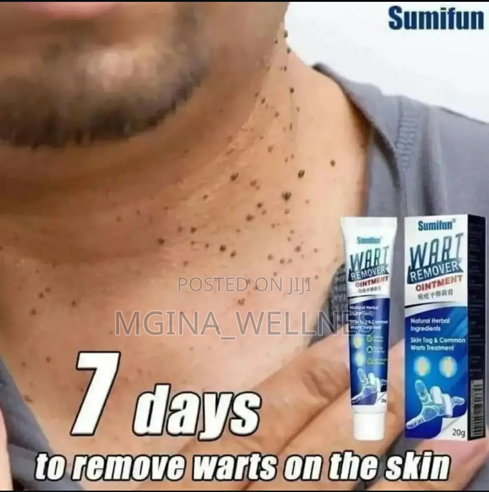 7 Warts Removal (Dawa Ya Kuondoa Visunzua Kwenye Ngozi)