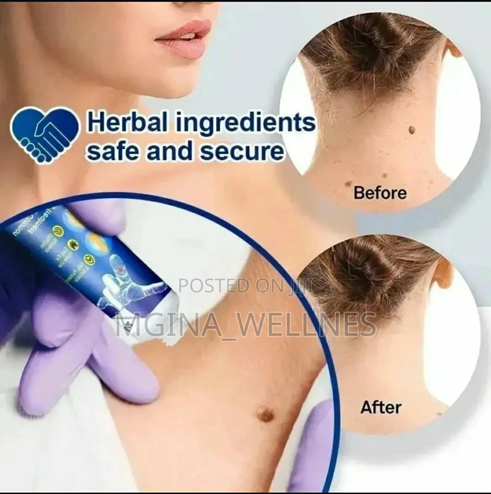 7 Warts Removal (Dawa Ya Kuondoa Visunzua Kwenye Ngozi)