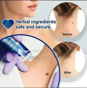 7 Warts Removal (Dawa Ya Kuondoa Visunzua Kwenye Ngozi)