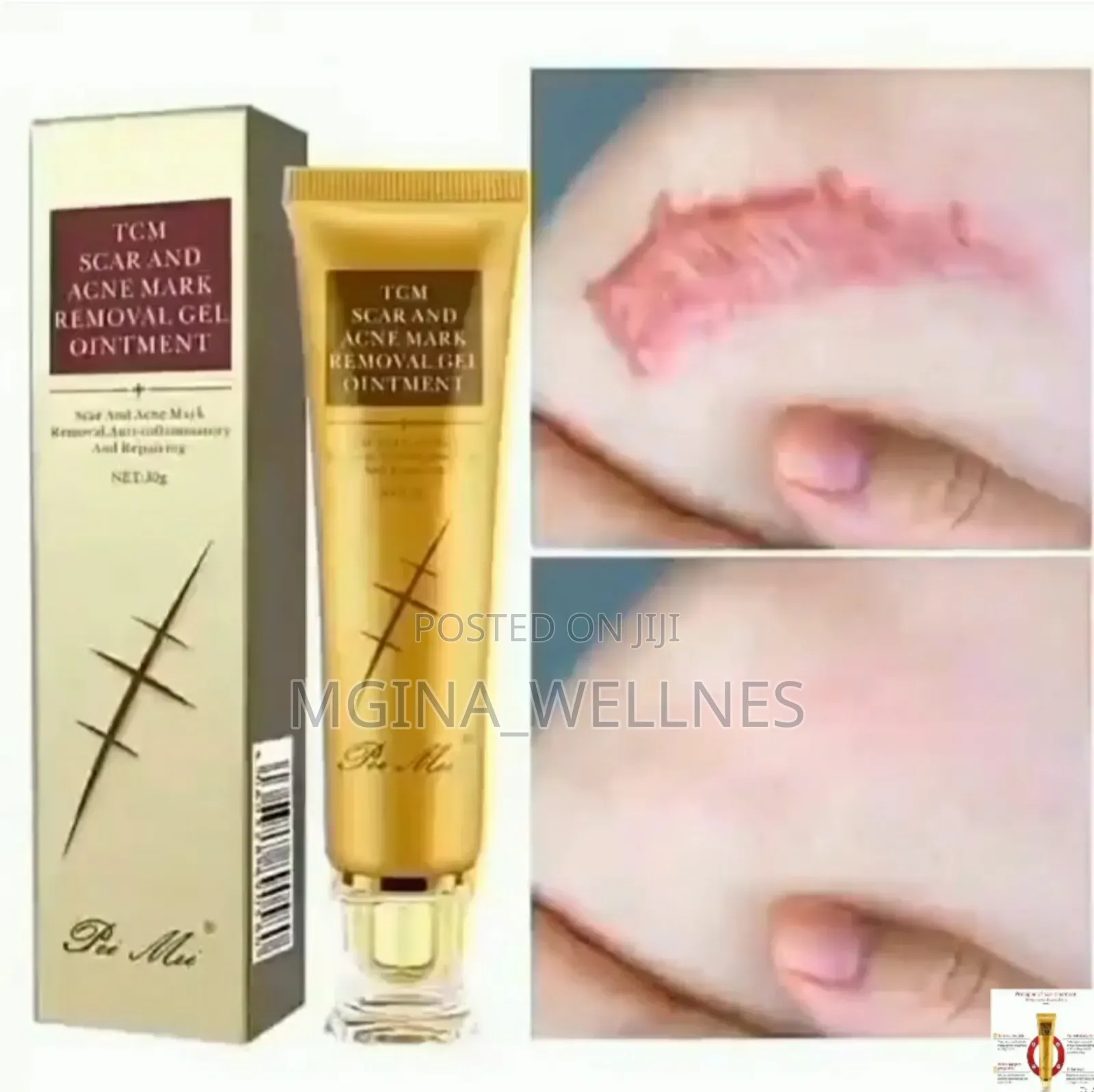 TCM Scar and Acne Mark Removal (Dawa Ya Kuondoa Makovu)