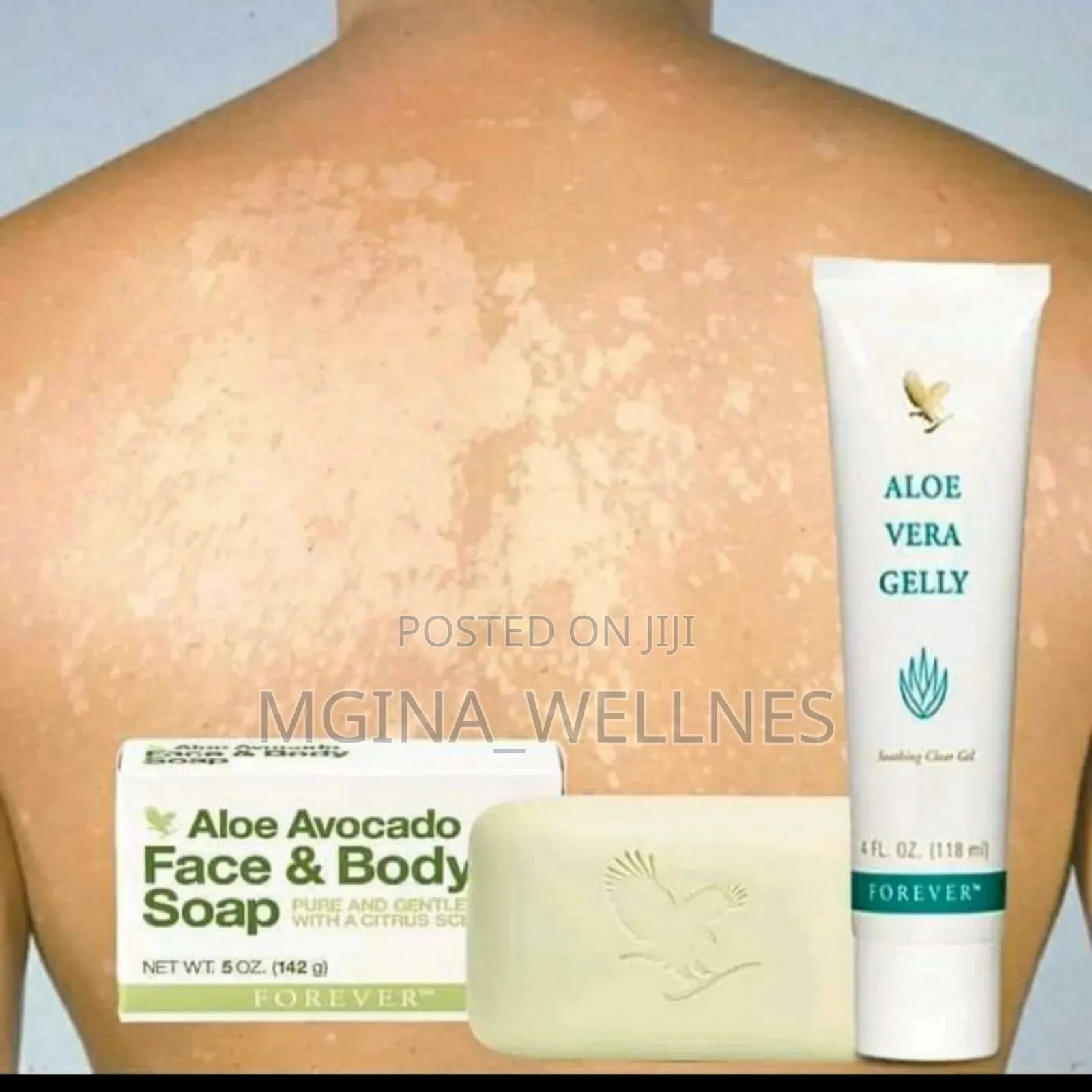 Pityriasis Versicolor Package ( Dawa Ya Mba Wa Ngozi)