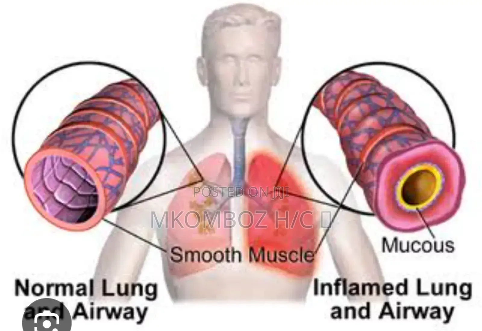 Tunatibu Na Kumaliza Pumu(Asthma) Kwa Siku 14 Tu