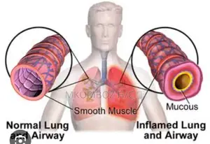 Tunatibu Na Kumaliza Pumu(Asthma) Kwa Siku 14 Tu