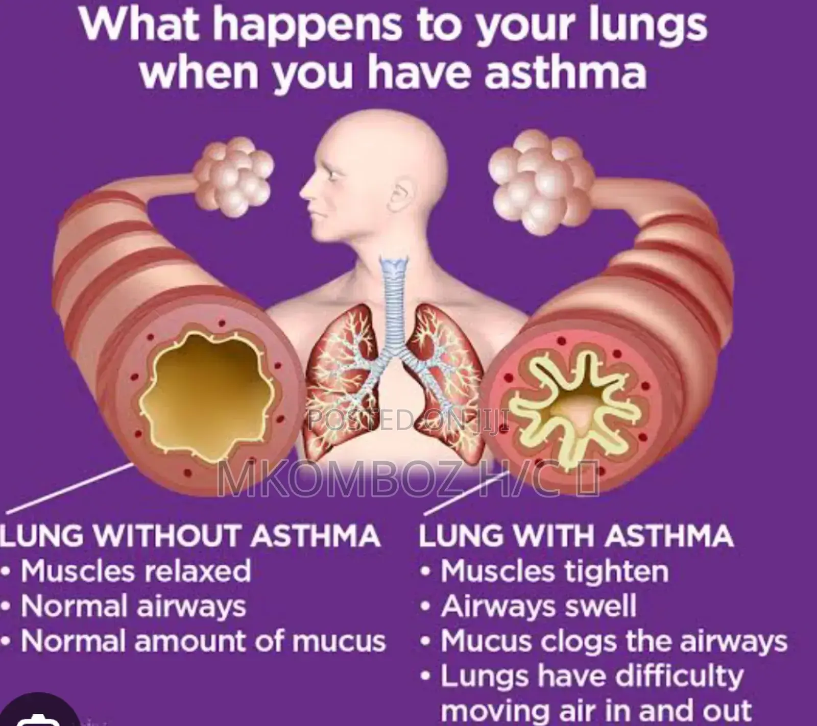 Tunatibu Na Kumaliza Pumu(Asthma) Kwa Siku 14 Tu