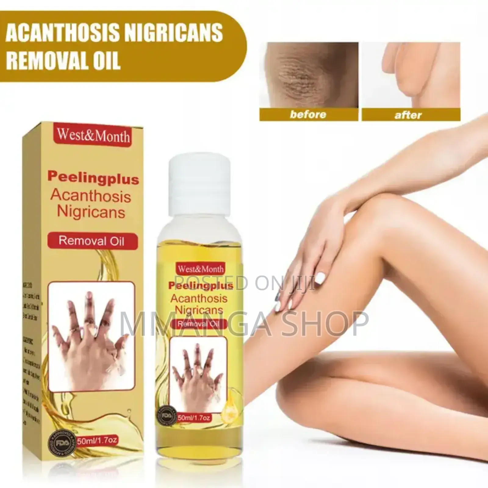 West Month Acanthosis Nigricans Removal Oil