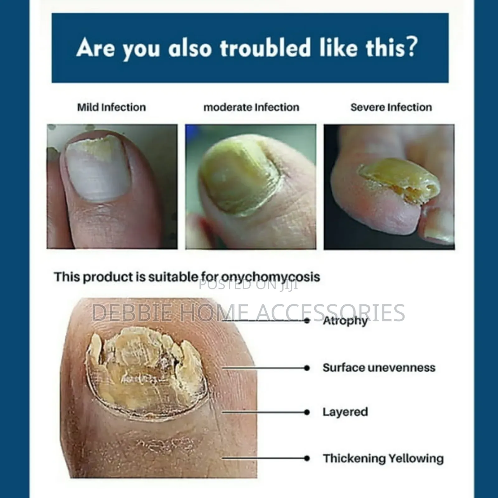 Nail Fungus Repair Ointment