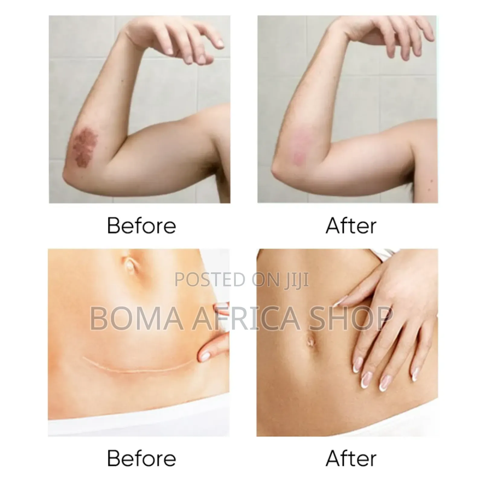 Scar and Acne Mark Removal Gel|Dawa Ya Kuondoa Makovu