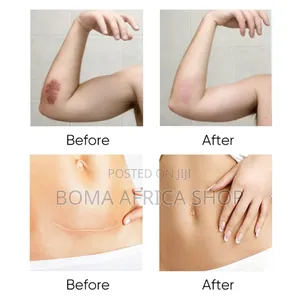 Scar and Acne Mark Removal Gel|Dawa Ya Kuondoa Makovu