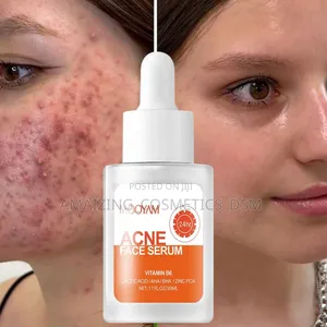 Acne Serum