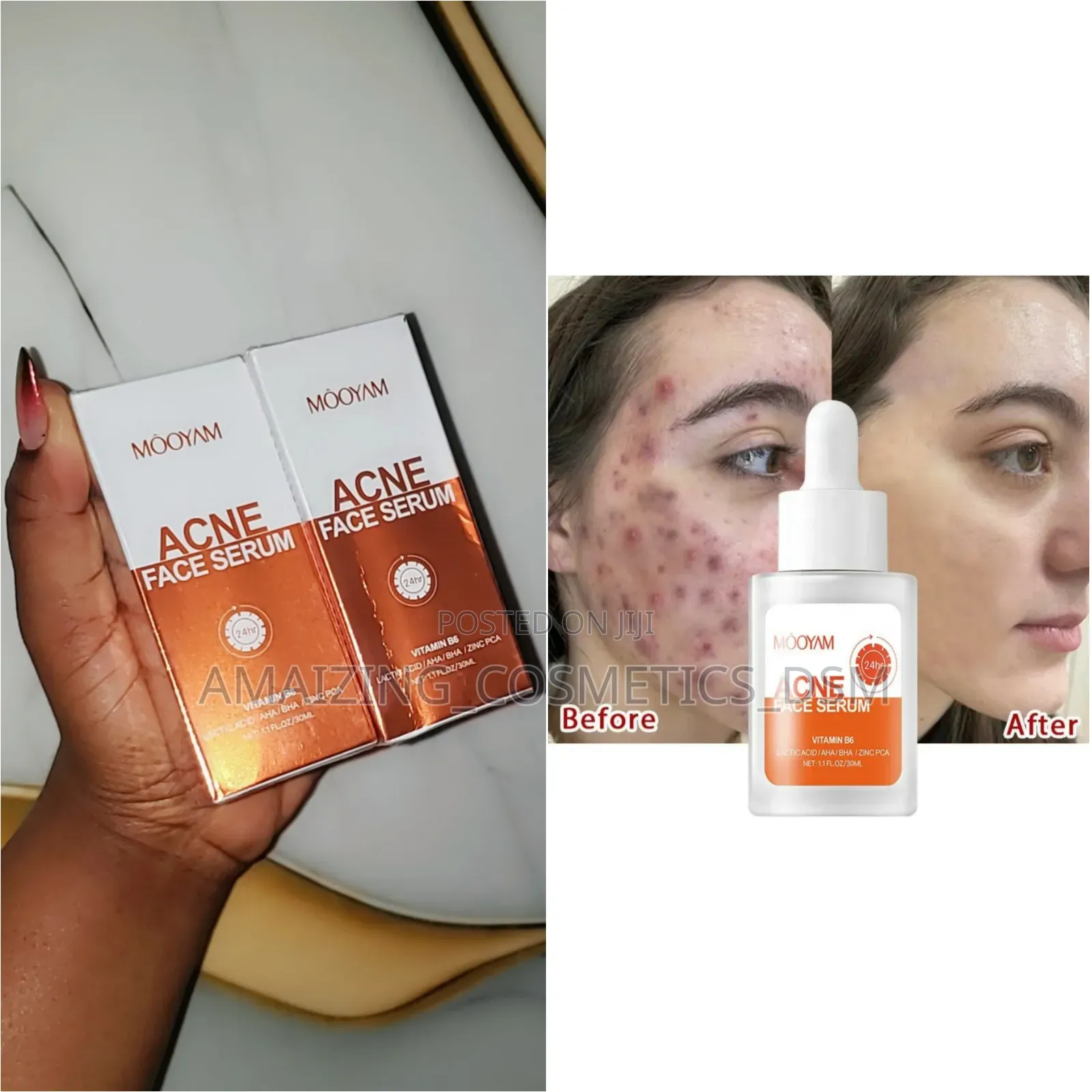 Acne Serum