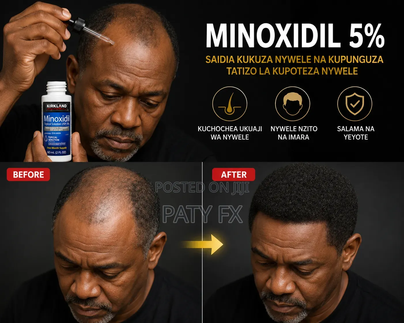 MINOXIDIL 5% (Bei Chee )