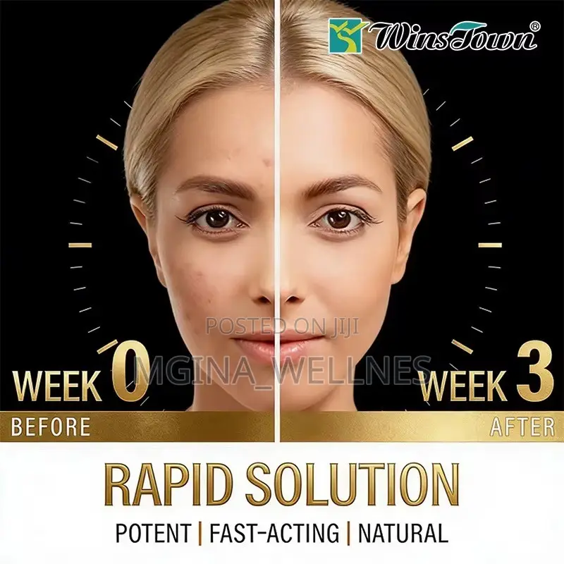 Acne Support Perfect Skin Dietary Supplement Capsules