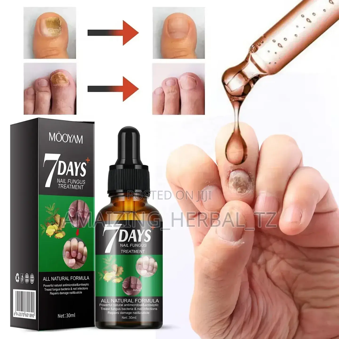 Nail Fungus Treatment